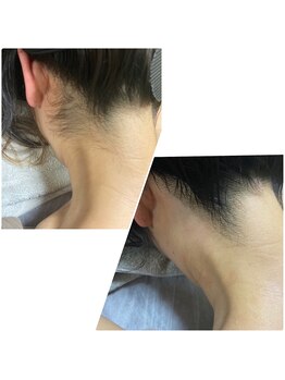 カルム(Calme)/うなじ脱毛