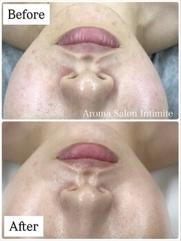 アンティミテ(Intimite)/パーソナルスキンケアコース