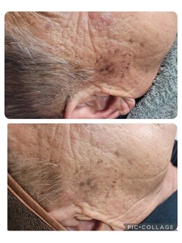 エスボーテ(sbeaute)/プラズマ+ヒト幹細胞培養上清液