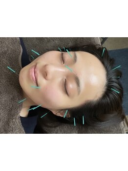 鍼灸施術を受けたい