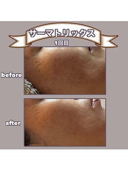 ビーマジック(美magic)/サーマトリックス