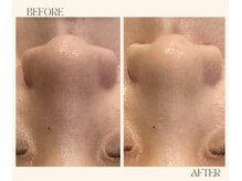 レヴ 都城店(rev)/毛穴洗浄でツルん