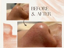 フィカス(FICUS)の雰囲気(肌質改善で人気のハービピーリング♪毛穴の汚れお任せ下さい♪)