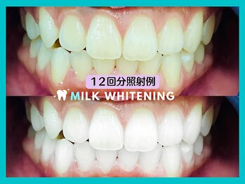 ミルクホワイトニング 長崎中央橋店(Milkホワイトニング)/◆施術例