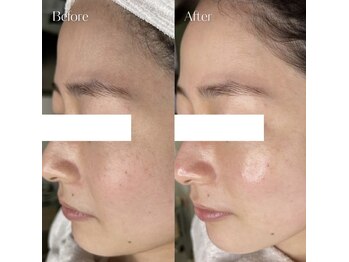 ミーバイ ミッシェル(me'by michelle)の写真/【韓国発の最新技術★毛穴の開き/黒ずみ/くすみに】ララピールで叶える、年齢を感じさせないツヤ美肌へ◎