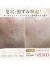 【毛穴黒ずみ・ニキビケア◎】カーボンピーリング通常￥10,000→￥8,000