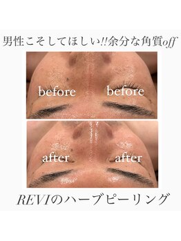 心斎橋 ルヴィ(REVI)/肌改善｜次世代ハーブピーリング