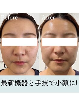 ピュア 川越店/小顔&美肌コース