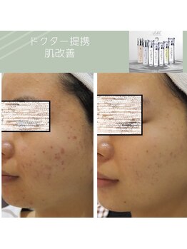 マリー エクラン/20代女性 ニキビケア