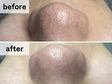 エアル(earu.)/BA|毛穴ケア|ピーリング|高円寺