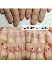5ヶ月間の自爪育成/深爪矯正