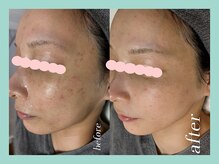 ミウル 天王寺店(miulu)/30代/シミケア照射＋ハーブ6回