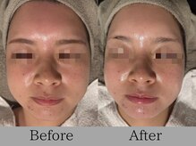 ルミライズ(lumirise)/〈1回目での効果〉