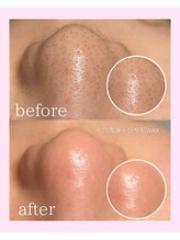 ディエール(Diailes)&nbsp;毛穴で お悩みの方