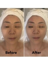 ナラビューティー(NARA BEAUTY)/全顔輪郭リフト1回　恵比寿小顔