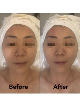 ナラビューティー(NARA BEAUTY)/全顔輪郭リフト1回 恵比寿小顔