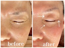 ルー ハナレ 神戸岡本 摂津本山店(Luu HANARE)/目元シワ改善　たるみケア