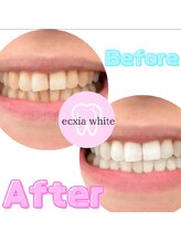 エクシアホワイトニング 新白河店/ホワイトニングビフォーアフター
