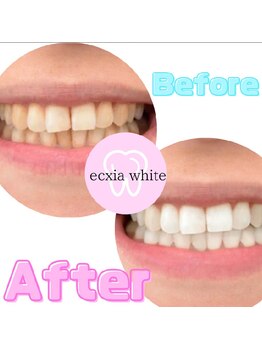 エクシアホワイトニング 新白河店/ホワイトニングビフォーアフター