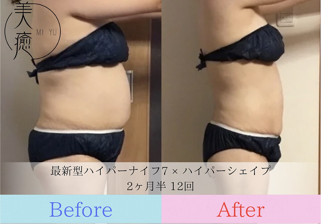 【値下げしました！】HyperKnife 美容機器 フェイシャル・ボディケア用 美癒 池袋本店｜ホットペッパービューティー