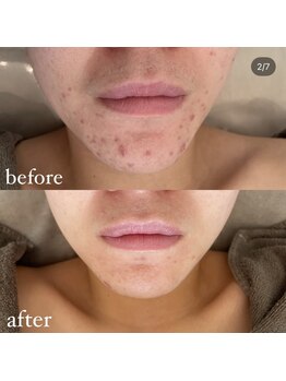 グレーシス(Graces)/繰り返すニキビをケア