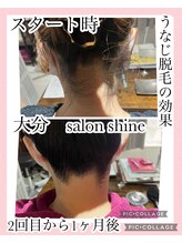 サロンシャイン(Salon Shine)/うなじ脱毛の経過
