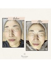 ネリネ(Nerine)/一年前よりも若くなる肌