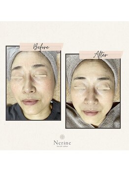 ネリネ(Nerine)/一年前よりも若くなる肌