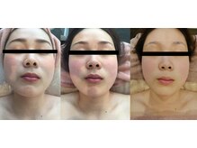 ナチュラルビューティーラボ(Natural Beauty Labo+)/NBL式顔筋リンパフェイシャルR