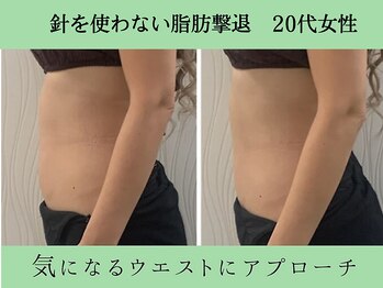 ソルニス(Solnis.)/痩身☆脂肪分解/ハイパーナイフ