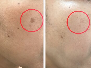 Beauty salon CENDRILLON【サンドリヨン】/肌質改善