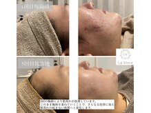 ラヴィオーラ 烏丸(LV)/ダイヤモンドハーブピーリング