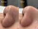 エクロール(E'clore)の写真/【韓国で大人気★】毛穴汚れ/黒ずみを徹底除去！施術直後から毛穴の目立たない毛穴レス肌に♪