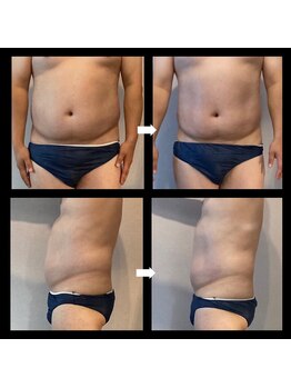 伊達男/フォースカッター事例