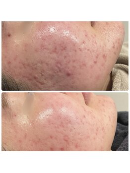 ニコリ(Nicori)/ハーブピーリング