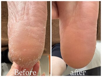 エクランプラス(Ecran+)/フットケア