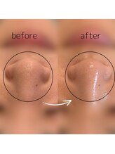 &still【アンドスティル】【4/1 NEW OPEN（予定）】 /【毛穴洗浄】ハイドロ