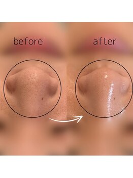 &still【アンドスティル】【4/1 NEW OPEN(予定)】 /【毛穴洗浄】ハイドロ