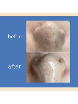 とびきりエステ 沼津店/Before→ After