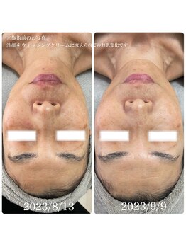 エステサロンブランシュ(Esthe salon Blanche)/ハーブピーリングでエイジング