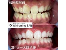 ホワイトニングバー 福島店/12回コース終了ビフォーアフター