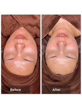 プライベートサロン アール(R)/カーボキシー×バンテージ