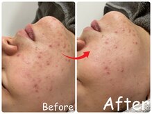 エレ(ele)/【施術1回】剥けるハーブ♪