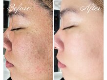 乾燥/くすみ対策ならプラズマ×美容液導入★内側からツヤ肌に