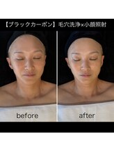 シスリー(CICELY)/『最新ブラックピーリング』