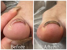 エクランプラス(Ecran+)/巻き爪ケア