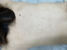 ナノハナ/鹿沼市の全身脱毛美容室ナノハナ