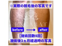 価格◎効果◎(右)8回施術後3か月経過