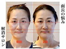 小顔22 ボルティ 赤坂支店(Bolty)/【面長の悩み】解消サロン