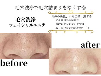 アルゴ 八幡黒崎店(ALGO)/いちご鼻卒業！毛穴洗浄＋光脱毛